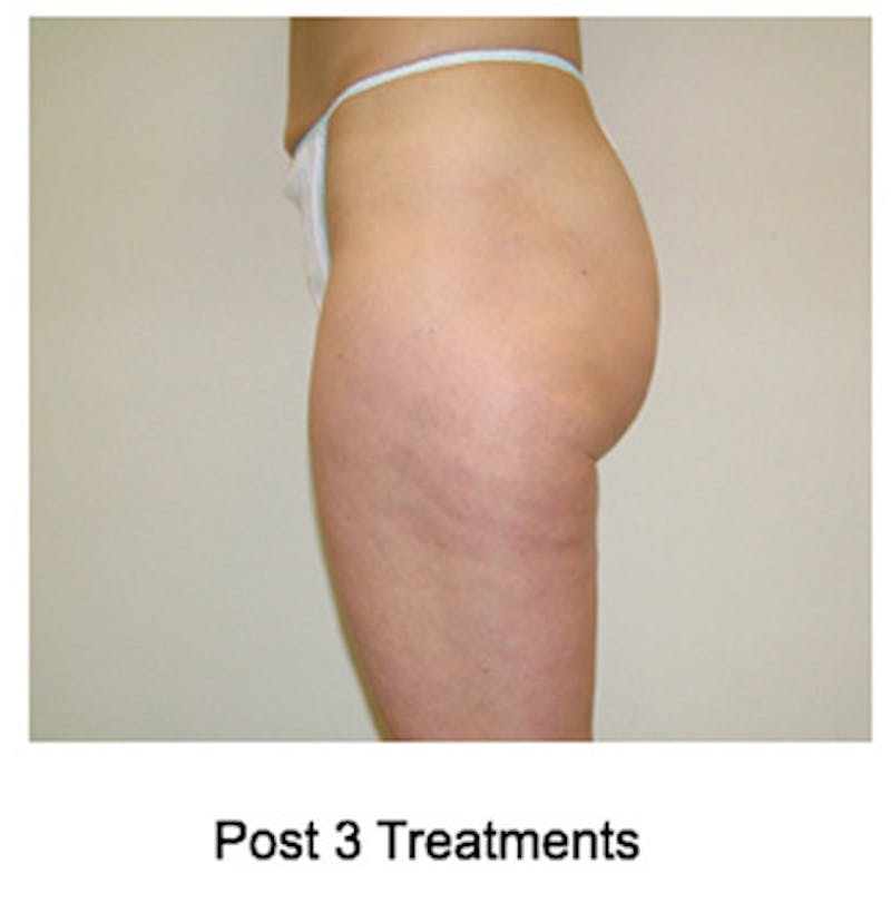 VelaShape Before & After Gallery - Patient 404413 - Image 4