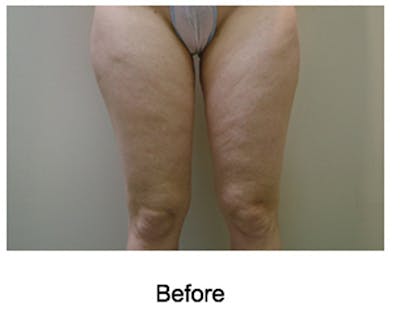 VelaShape Before & After Gallery - Patient 450292 - Image 1