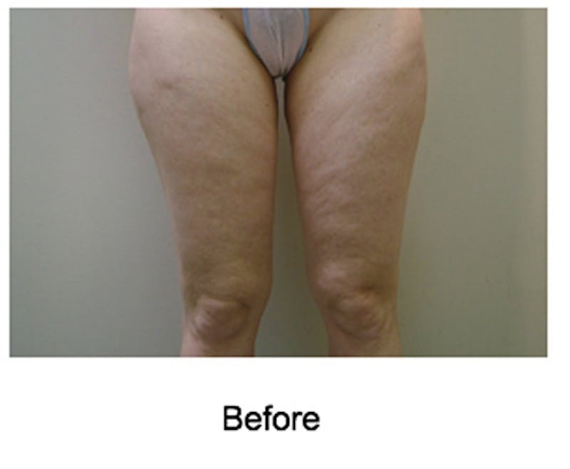 VelaShape Before & After Gallery - Patient 450292 - Image 1