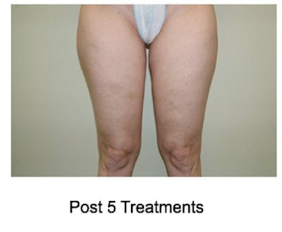 VelaShape Before & After Gallery - Patient 450292 - Image 2