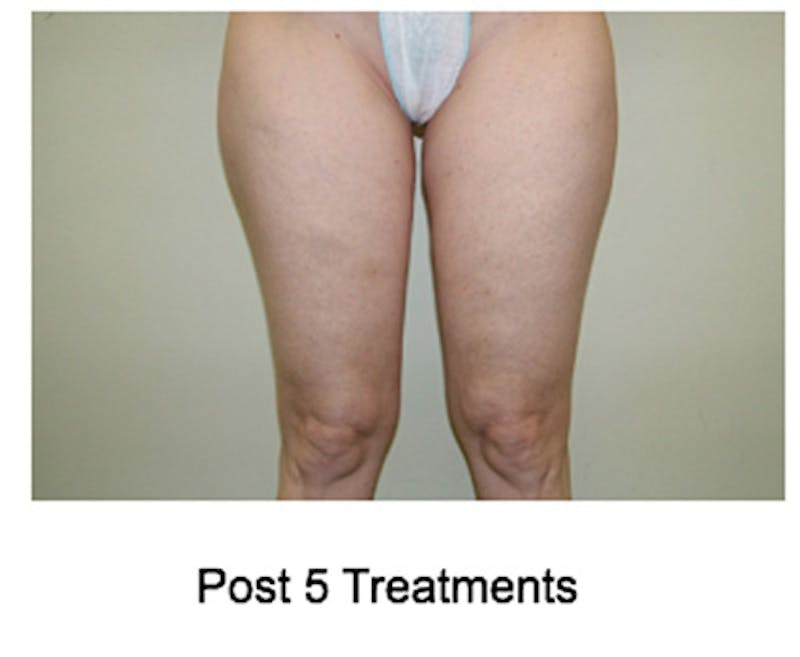 VelaShape Before & After Gallery - Patient 450292 - Image 2