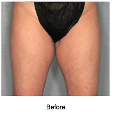 VelaShape Before & After Gallery - Patient 106133 - Image 1