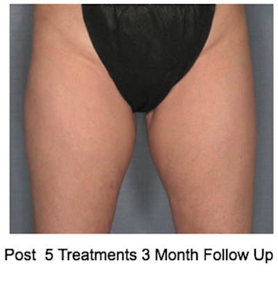 VelaShape Before & After Gallery - Patient 106133 - Image 2