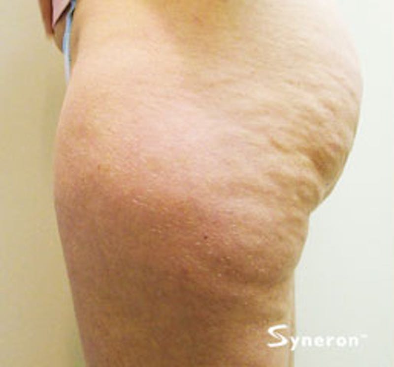 VelaShape Before & After Gallery - Patient 967211 - Image 1