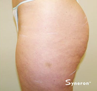 VelaShape Before & After Gallery - Patient 967211 - Image 2