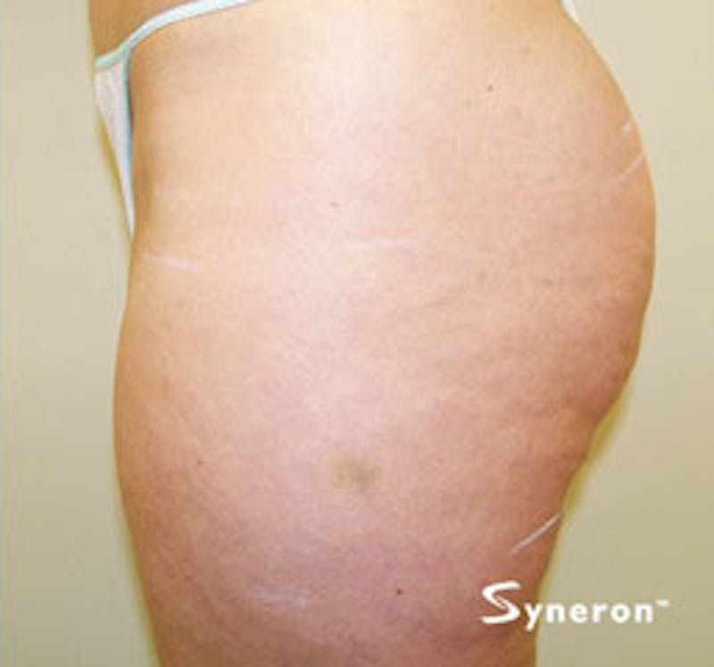 VelaShape Before & After Gallery - Patient 967211 - Image 2
