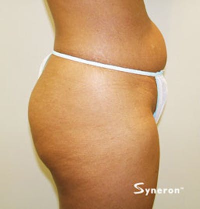 VelaShape Before & After Gallery - Patient 322882 - Image 1