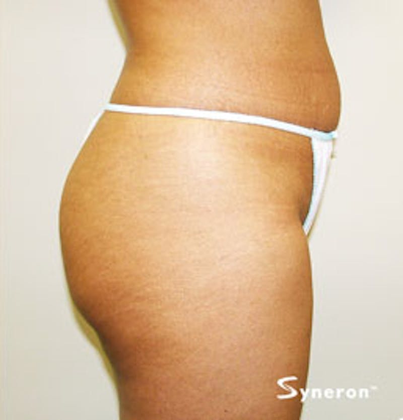 VelaShape Before & After Gallery - Patient 322882 - Image 2