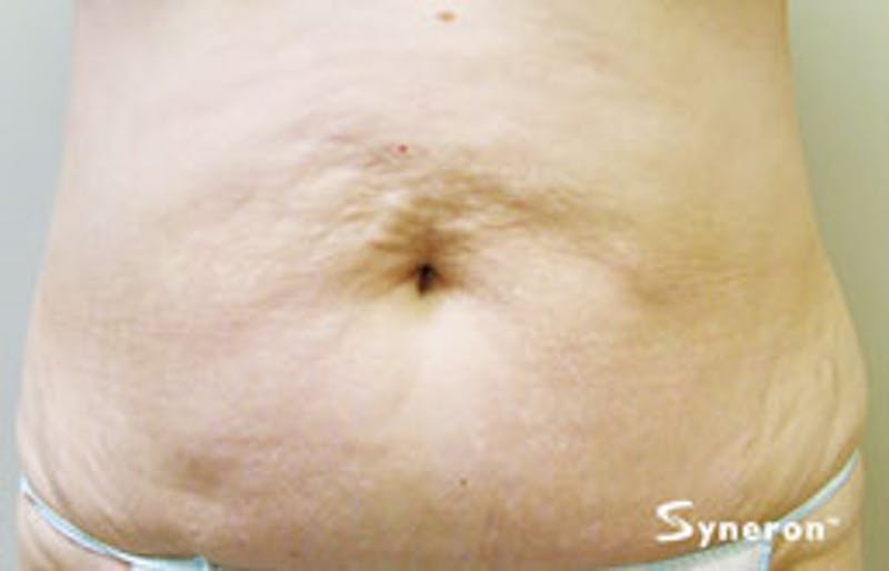 VelaShape Before & After Gallery - Patient 364343 - Image 1