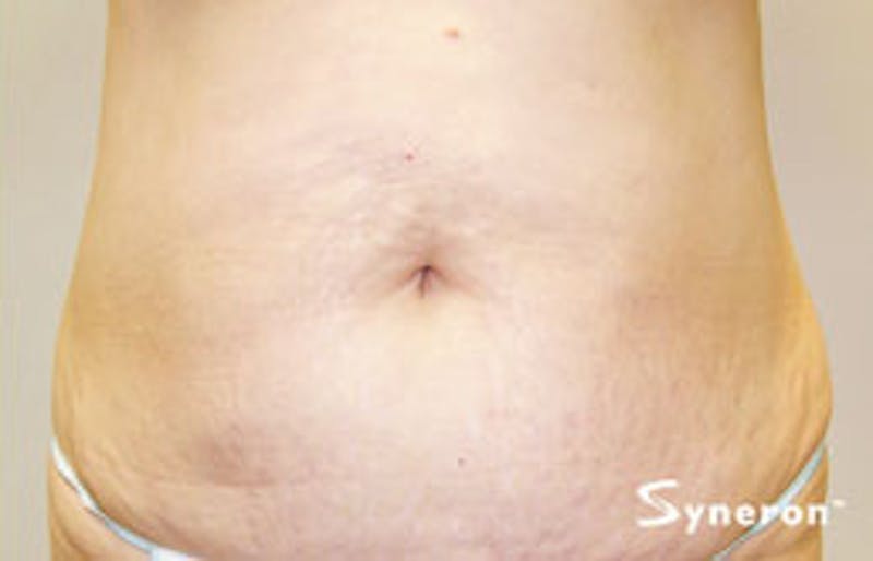 VelaShape Before & After Gallery - Patient 364343 - Image 2