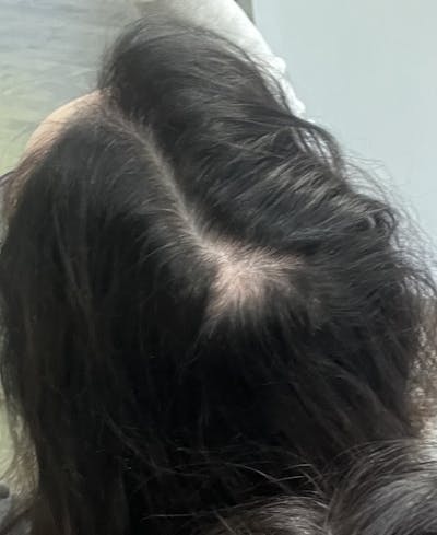 PRP Hair Restoration Before & After Gallery - Patient 112303 - Image 1