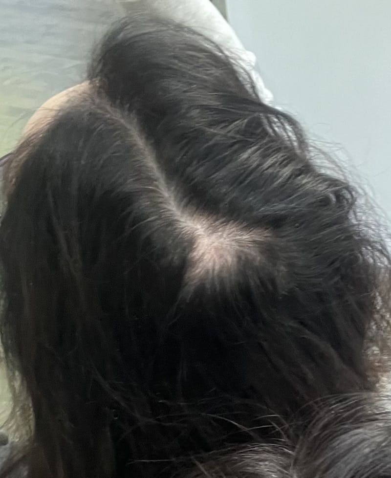 PRP Hair Restoration Before & After Gallery - Patient 112303 - Image 1