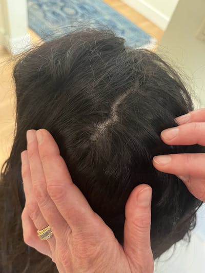 PRP Hair Restoration Before & After Gallery - Patient 112303 - Image 2