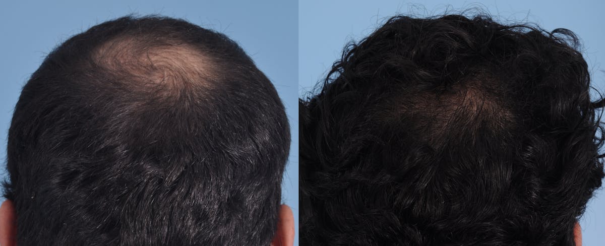 Hair Graft Surgery Before & After Gallery - Patient 264547 - Image 1