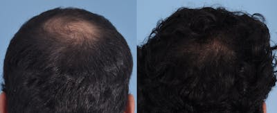 Hair Graft Surgery Before & After Gallery - Patient 264547 - Image 1