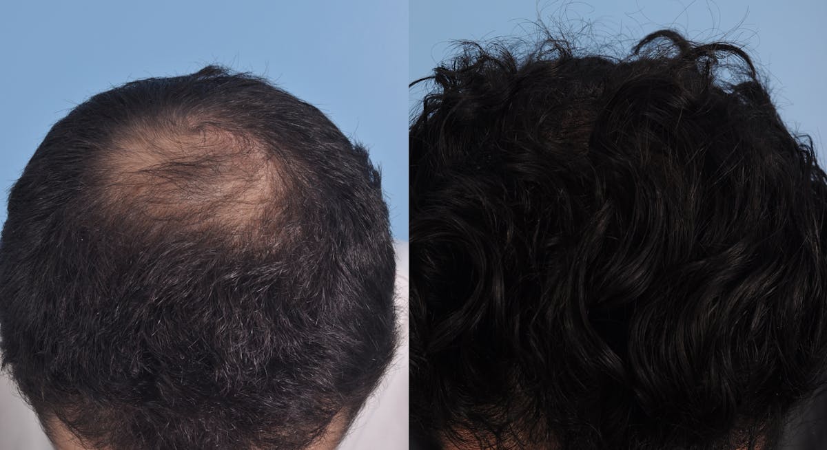 Hair Graft Surgery Before & After Gallery - Patient 264547 - Image 2