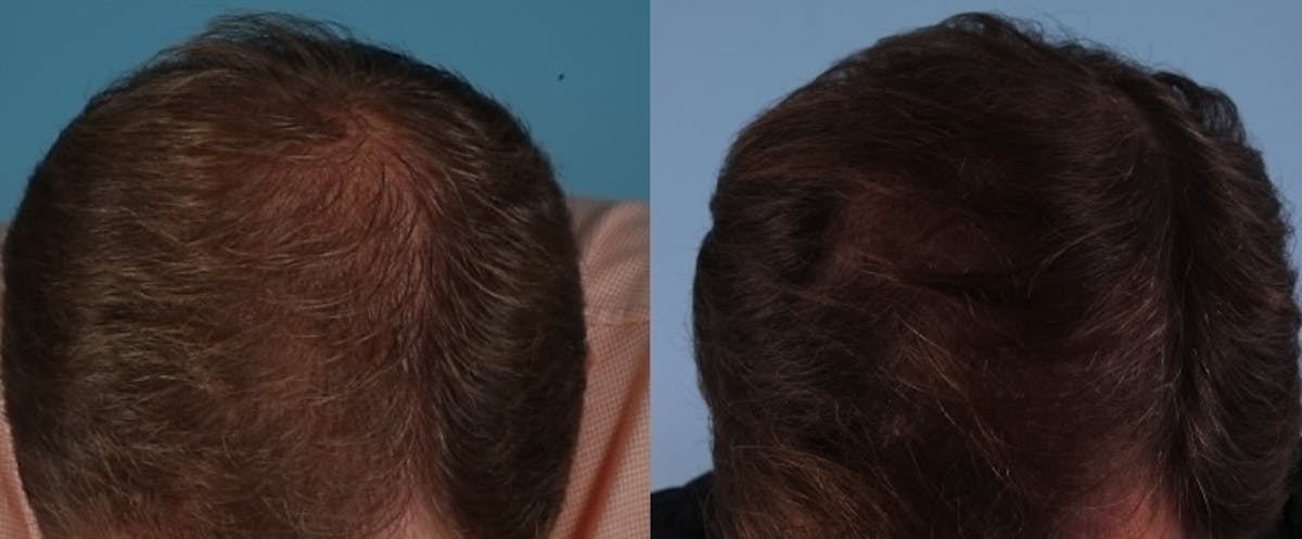 Hair Graft Surgery Before & After Gallery - Patient 246468 - Image 1
