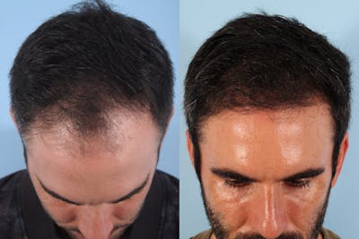 Hair Graft Surgery Before & After Gallery - Patient 690485 - Image 1