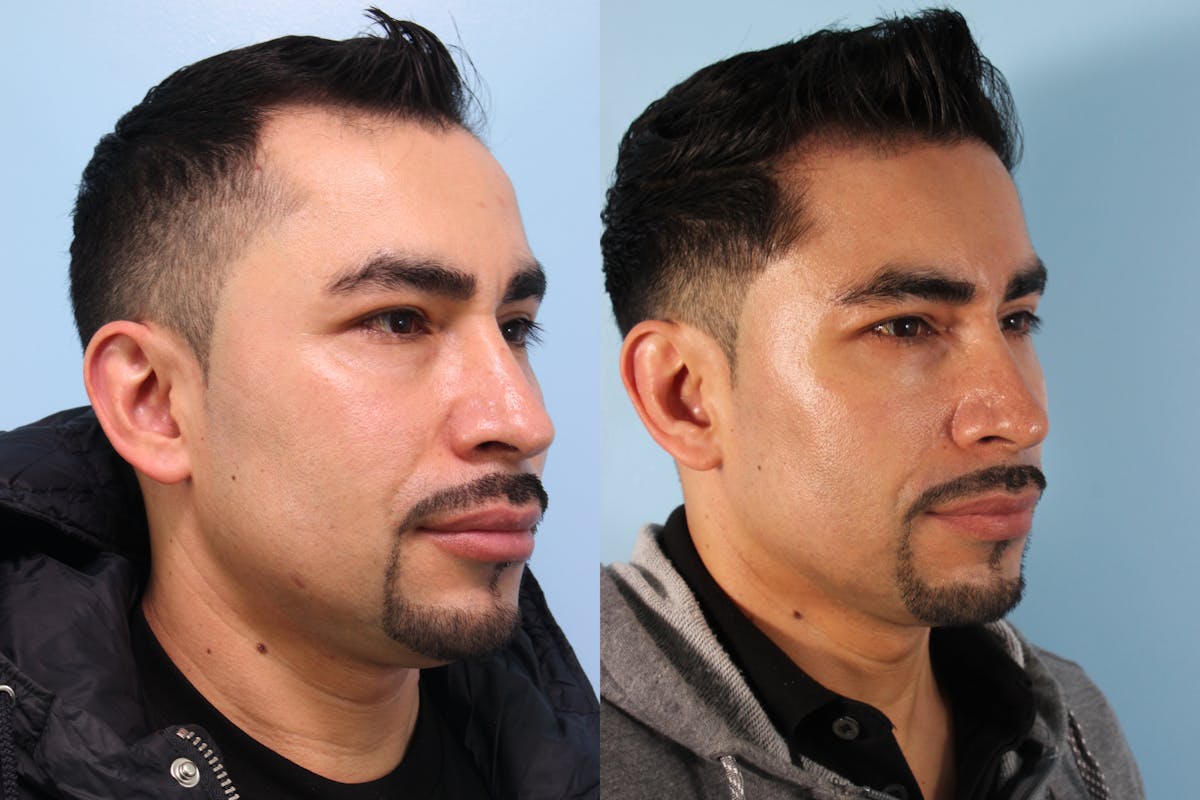 Hair Graft Surgery Before & After Gallery - Patient 241353 - Image 3
