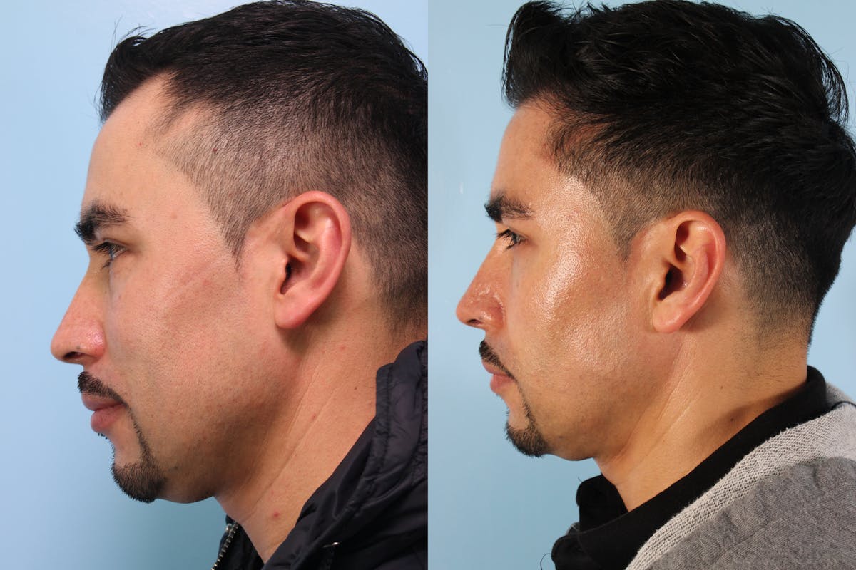 Hair Graft Surgery Before & After Gallery - Patient 241353 - Image 6