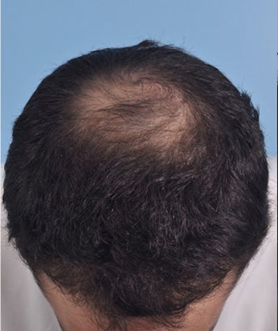 Hair Graft Surgery Before & After Gallery - Patient 418179 - Image 1
