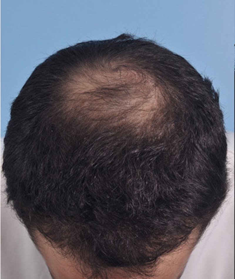 Hair Graft Surgery Before & After Gallery - Patient 418179 - Image 1