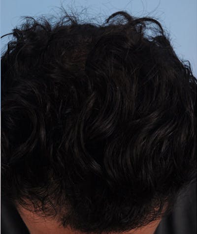 Hair Graft Surgery Before & After Gallery - Patient 418179 - Image 2