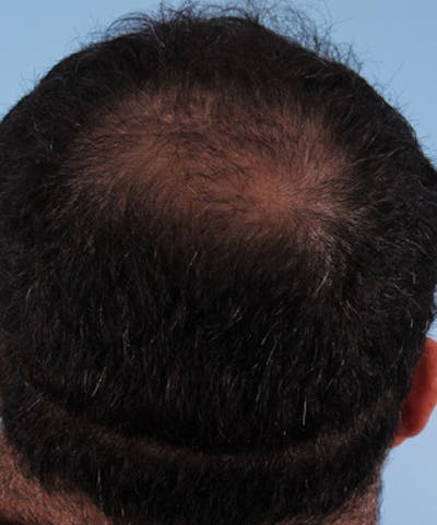 Hair Graft Surgery Before & After Gallery - Patient 414501 - Image 2
