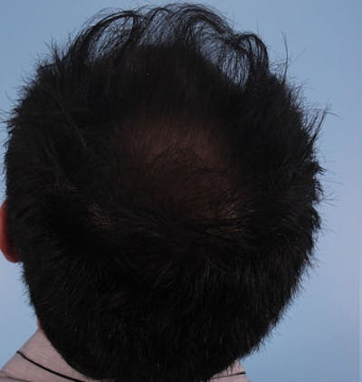 Hair Graft Surgery Before & After Gallery - Patient 278683 - Image 1