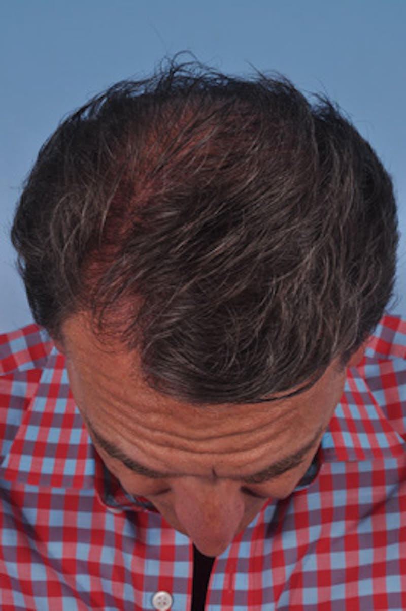 Hair Graft Surgery Before & After Gallery - Patient 288134 - Image 2