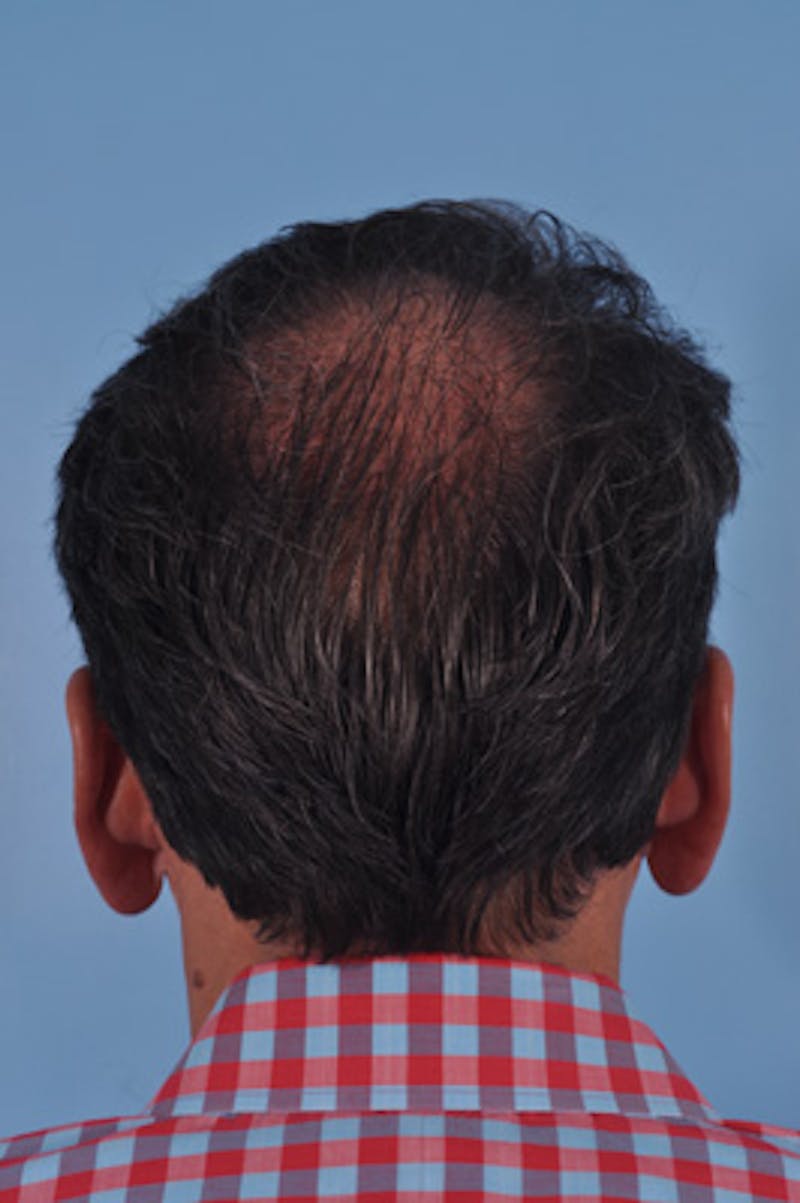 Hair Graft Surgery Before & After Gallery - Patient 288134 - Image 4