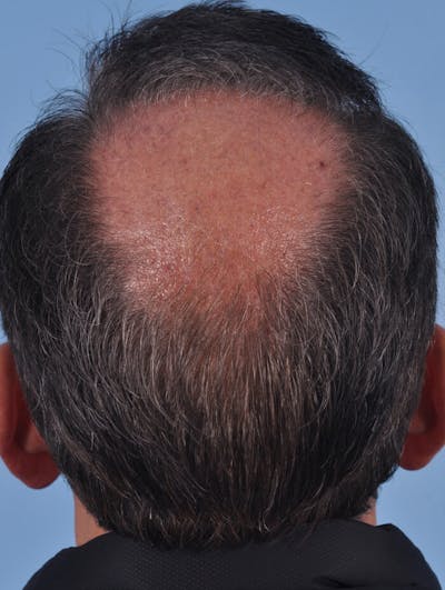 Hair Graft Surgery Before & After Gallery - Patient 871217 - Image 1