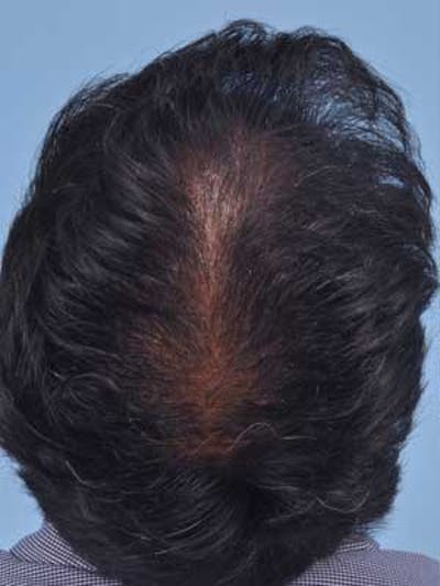 Hair Graft Surgery Before & After Gallery - Patient 222159 - Image 1