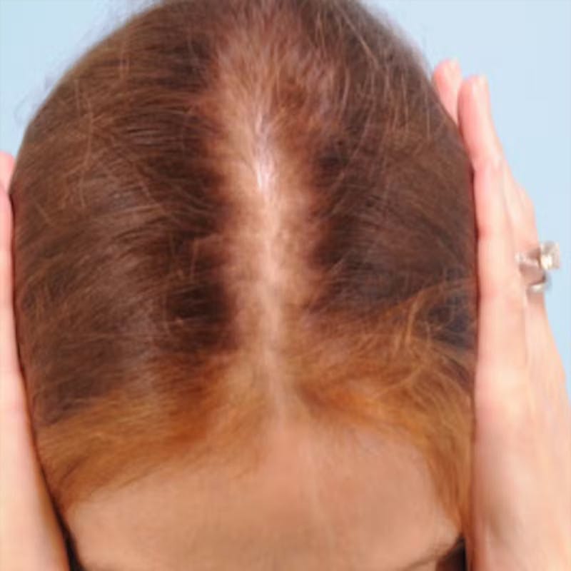 Hair Graft Surgery Before & After Gallery - Patient 532499 - Image 1