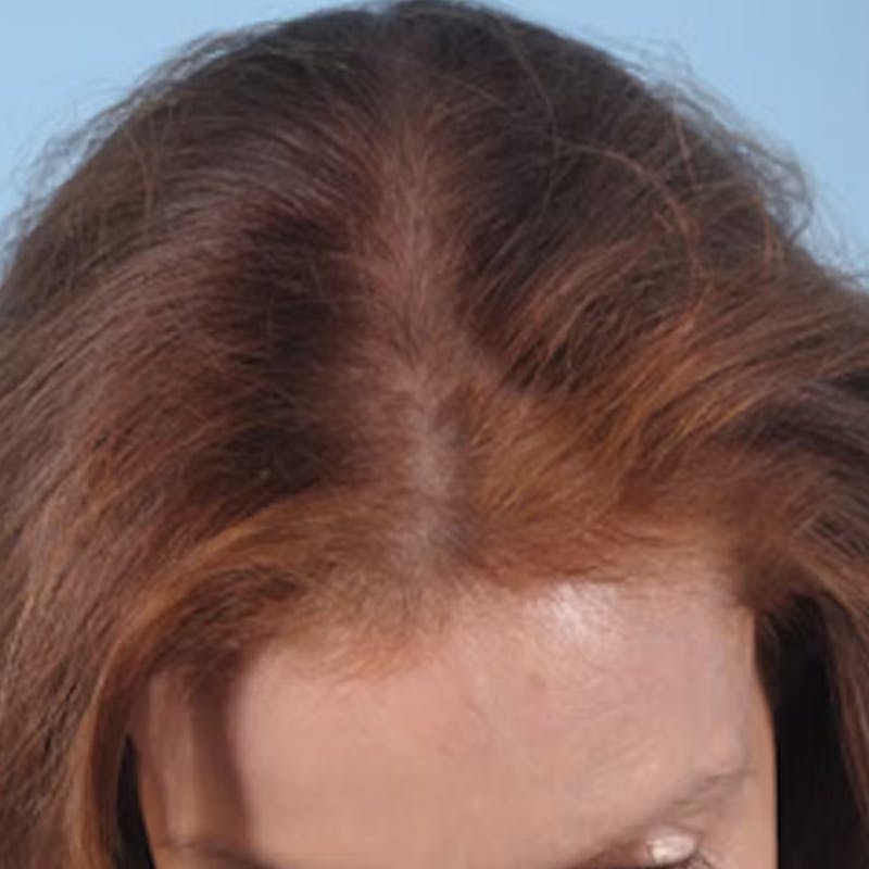 Hair Graft Surgery Before & After Gallery - Patient 532499 - Image 2