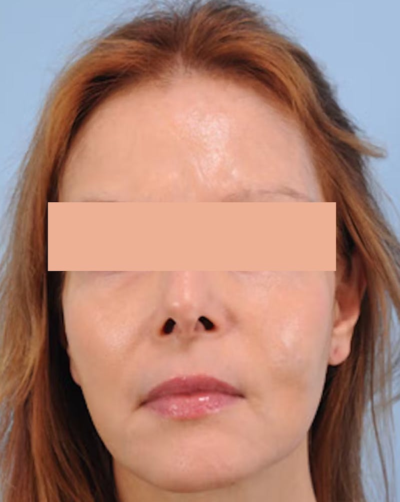 Hair Graft Surgery Before & After Gallery - Patient 532499 - Image 5