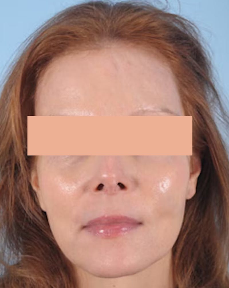 Hair Graft Surgery Before & After Gallery - Patient 532499 - Image 6