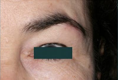 Mustache, Eyebrow Grafts Before & After Gallery - Patient 280545 - Image 2