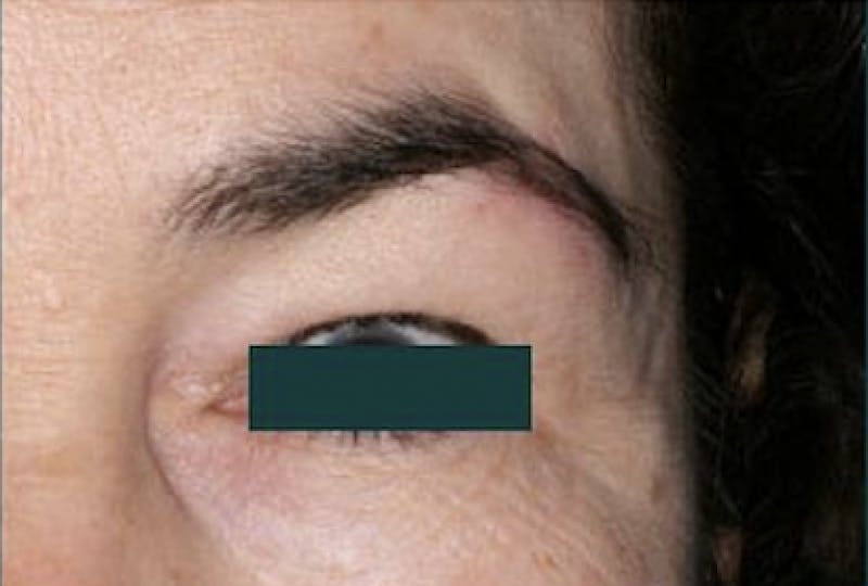 Mustache, Eyebrow Grafts Before & After Gallery - Patient 280545 - Image 2