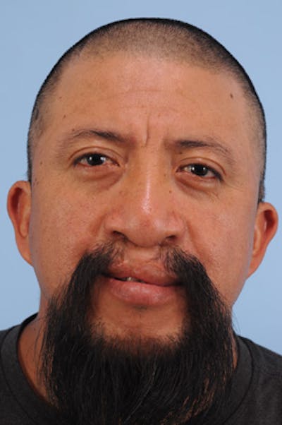 Mustache, Eyebrow Grafts Before & After Gallery - Patient 214959 - Image 1