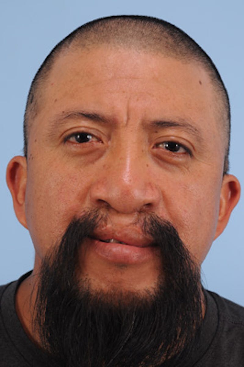 Mustache, Eyebrow Grafts Before & After Gallery - Patient 214959 - Image 1