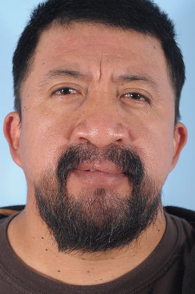 Mustache, Eyebrow Grafts Before & After Gallery - Patient 214959 - Image 2