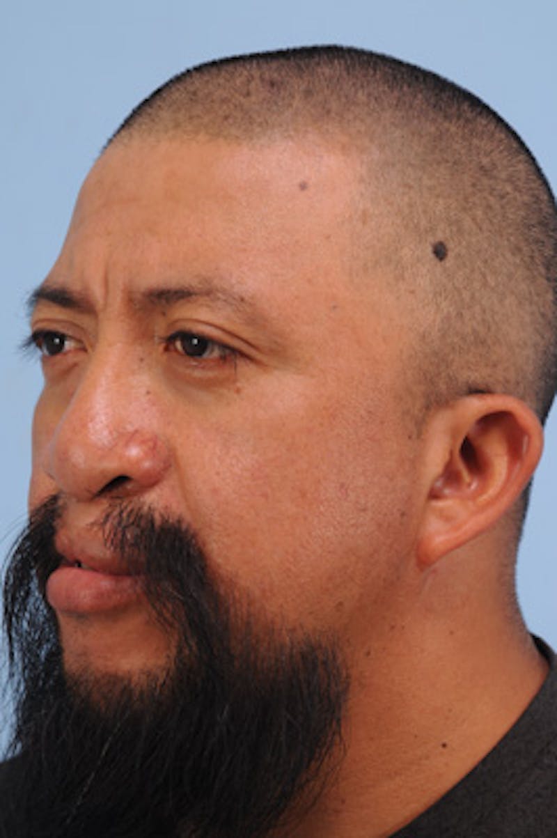 Mustache, Eyebrow Grafts Before & After Gallery - Patient 214959 - Image 3