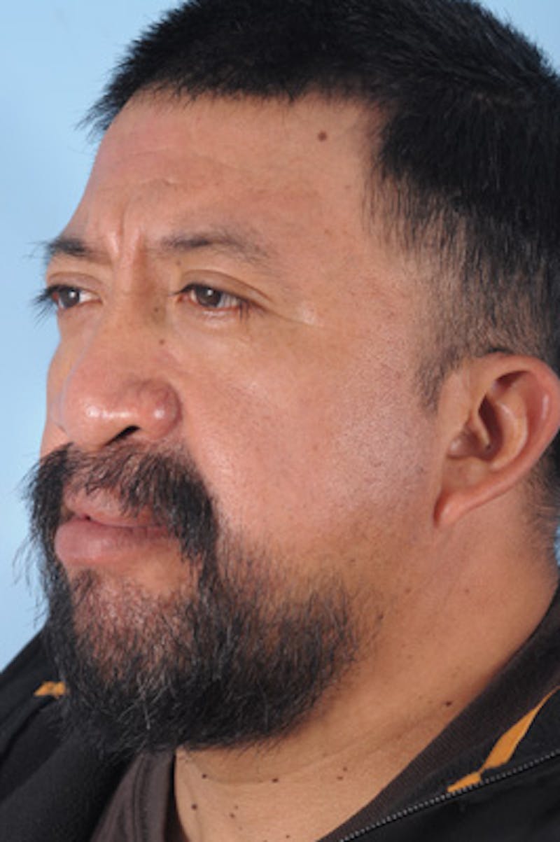 Mustache, Eyebrow Grafts Before & After Gallery - Patient 214959 - Image 4