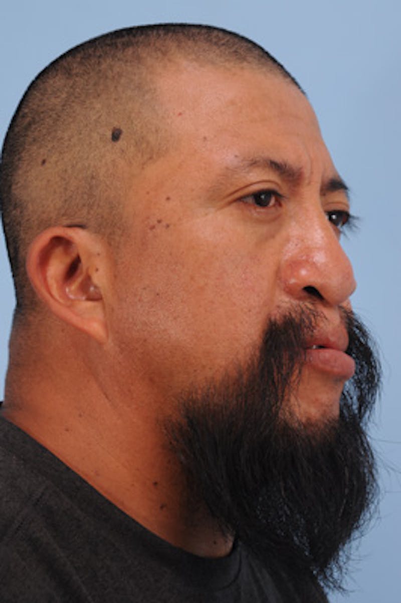 Mustache, Eyebrow Grafts Before & After Gallery - Patient 214959 - Image 5