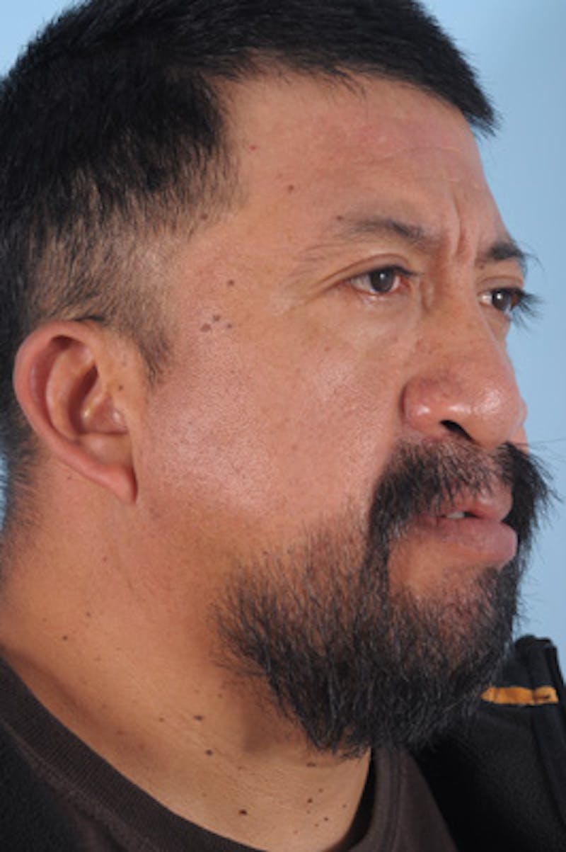 Mustache, Eyebrow Grafts Before & After Gallery - Patient 214959 - Image 6