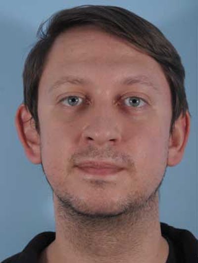 Mustache, Eyebrow Grafts Before & After Gallery - Patient 193841 - Image 1