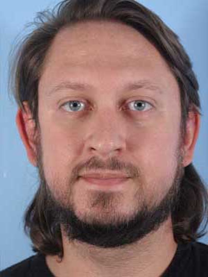 Mustache, Eyebrow Grafts Before & After Gallery - Patient 193841 - Image 2