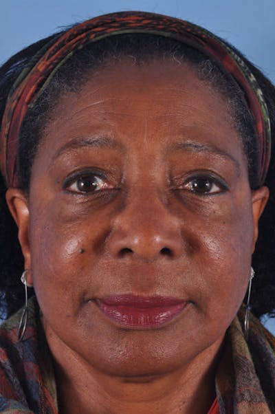 Mustache, Eyebrow Grafts Before & After Gallery - Patient 108555 - Image 1