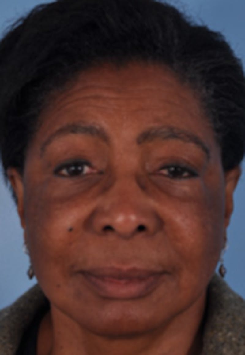 Mustache, Eyebrow Grafts Before & After Gallery - Patient 108555 - Image 2